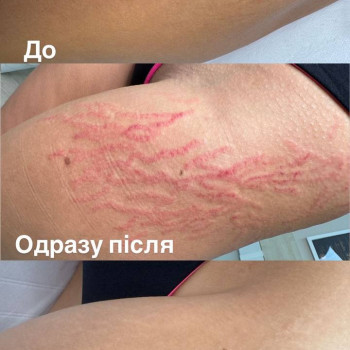 Мікронідлінг( видалення розтяжок та шрамів)
                    Мастер перманентного макияжа Тетяна Киев