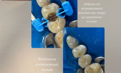 Лікування карієсу Стоматолог Юлия Полтава