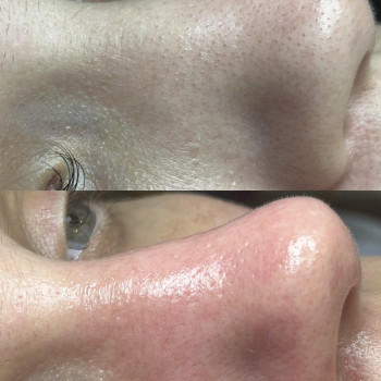 Комбінована чистка обличчя
                    Косметолог-естетист Анастасия Дніпро