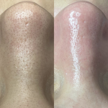 Комбінована чистка обличчя
                    Косметолог-естетист Анастасия Дніпро