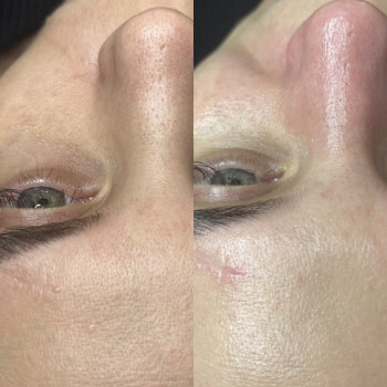 Комбінована чистка обличчя
                    Косметолог-естетист Анастасия Дніпро