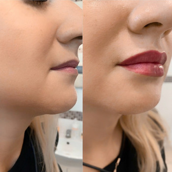 Корекція форми губ
                    Косметолог Юлия Харьков