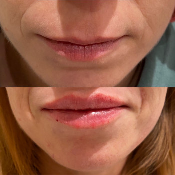 Корекція форми губ
                    Косметолог Юлия Харьков
