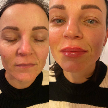 Корекція форми губ
                    Косметолог Юлия Харьков