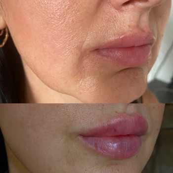 Корекція форми губ
                    Косметолог Юлия Харьков