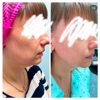 SMAS-lifting. Результат після однієї процедури