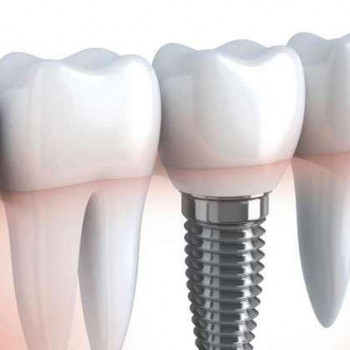 Імплантація по шаблону  / імплант  Alpha Dent
                    Стоматолог Петро Рівне