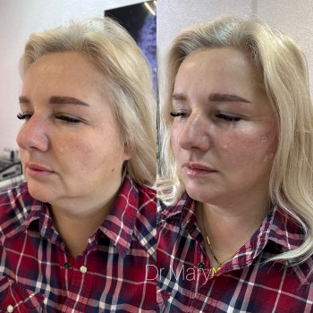 Нитковий ліфтинг