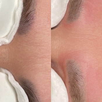 Одразу після процедури лазерного видалення