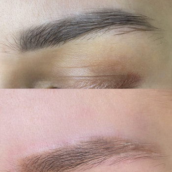 Одразу після процедури лазерного видалення