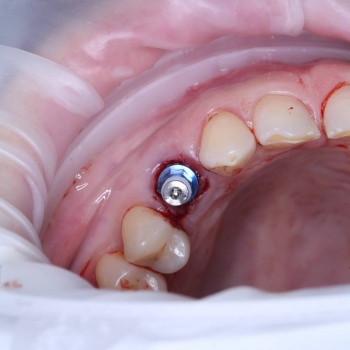 Імплантація по шаблону  / імплант  Alpha Dent
                    Стоматолог Петро Рівне