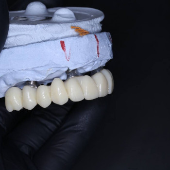 Концепт All-in-6 з тимчасовим протезуванням
                    Стоматолог Петро Рівне