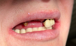 Концепт All-in-4 з тимчасовим протезуванням Стоматолог Петро Ровно