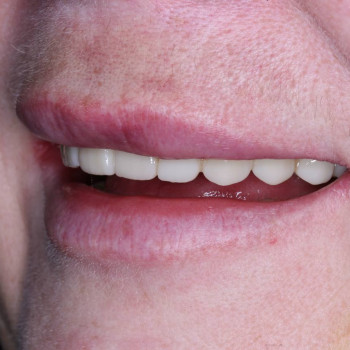 Концепт All-in-6 з тимчасовим протезуванням
                    Стоматолог Петро Рівне