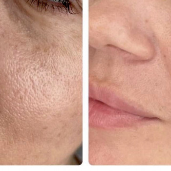 Лазерная шлифовка лица и тела
                    Косметологічний центр Beautymed Clinic Запоріжжя