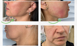 Ultraformer MPT смас ліфтинг Косметологический центр Beautymed Clinic Запорожье