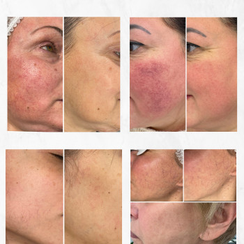 Лечение пигментации IPL LUMECCA
                    Косметологический центр Beautymed Clinic Запорожье