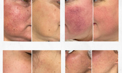 Лечение пигментации IPL LUMECCA Косметологический центр Beautymed Clinic Запорожье