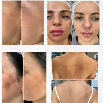 Лечение пигментации IPL LUMECCA
                    Косметологический центр Beautymed Clinic Запорожье
