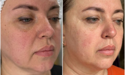 Morpheus 8 мікроголковий RF ліфтинг Косметологічний центр Beautymed Clinic Запоріжжя