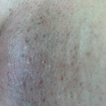 Чистка бікіні (спа процедура), фото ДО
Тривалість: 1 година 
Ціна: 500 грн