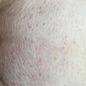 Чистка бікіні (спа процедура), фото Після
Тривалість: 1 година 
Ціна: 500 грн