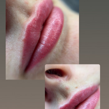 Загоєні губки після первинної процедури