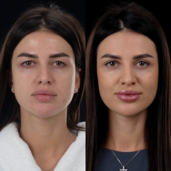 Марина Юрченко, Буковель Фото - 1