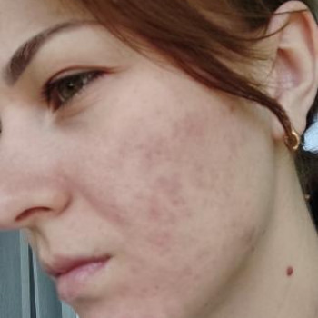 після процедури