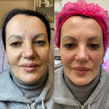  
Виконана волюмінізація обличчя за допомогою філлеру на основі гіалуронової кислоти