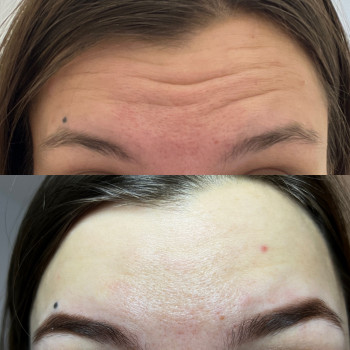 Ботулінотерапія лоба
                    Косметолог Ксенія Ужгород