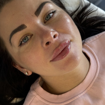 Збільшення губ / Контурна пластика губ / Ботокс / FULLFACE Васильків