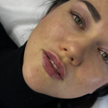 Збільшення губ / Контурна пластика губ / Ботокс / FULLFACE Васильків