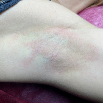 Одразу після процедури