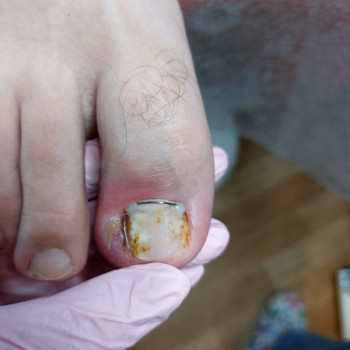 Обробка врослого нігтя
                    Подолог Ольга Одеса