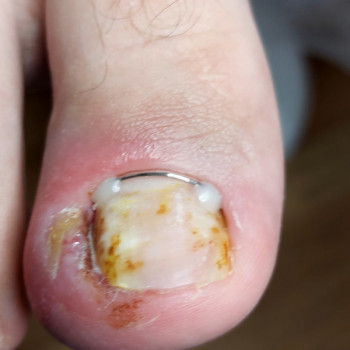 Обробка врослого нігтя
                    Подолог Ольга Одеса