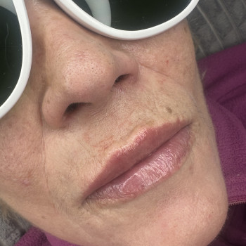 Вікові губи