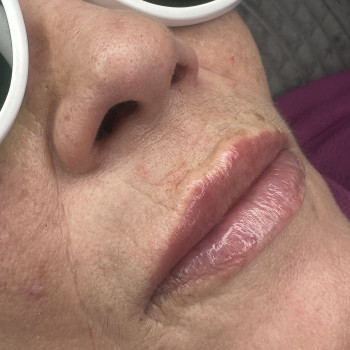 Вікові губи