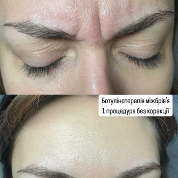 Ботулінотерапія
                    Косметолог Уляна Львів