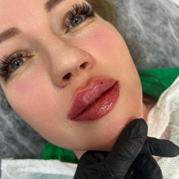 Корекція губ # , повторна процедура