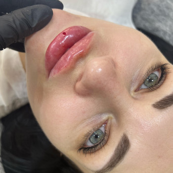 Корекція форми та об’єму губ # повторна процедура