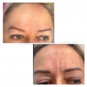 Корекція зморшок лоб # та міжбріржвʼя #