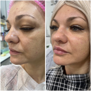 Корекція середньої третини обличчя #