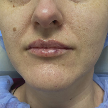 Контурная пластика губ
                    Дерматолог косметолог Алёна Николаев