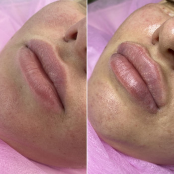 Контурная пластика губ
                    Дерматолог косметолог Алёна Николаев