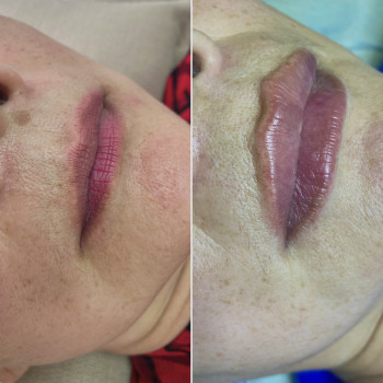 Контурная пластика губ
                    Дерматолог косметолог Алёна Николаев