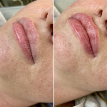 Контурная пластика губ
                    Дерматолог косметолог Алёна Николаев