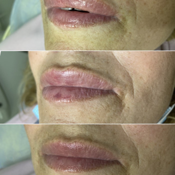 Контурная пластика губ
                    Дерматолог косметолог Алёна Николаев