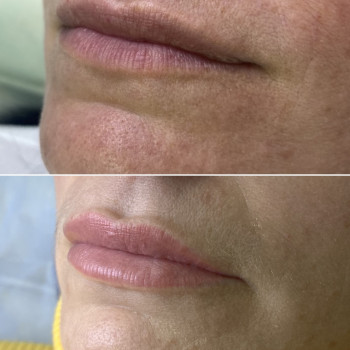 Контурная пластика губ
                    Дерматолог косметолог Алёна Николаев