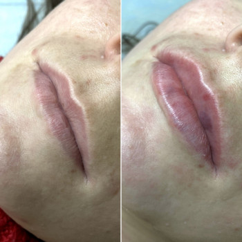 Контурная пластика губ
                    Дерматолог косметолог Алёна Николаев